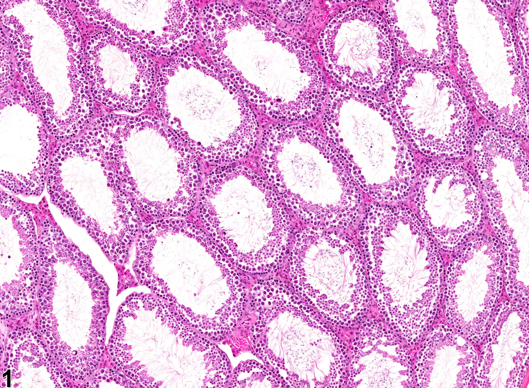 Blocked Seminiferous Tubules
